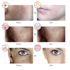 Máscara Facial LED 7 Cores para rejuvenescimento, tratamento antiacne e antirrugas.