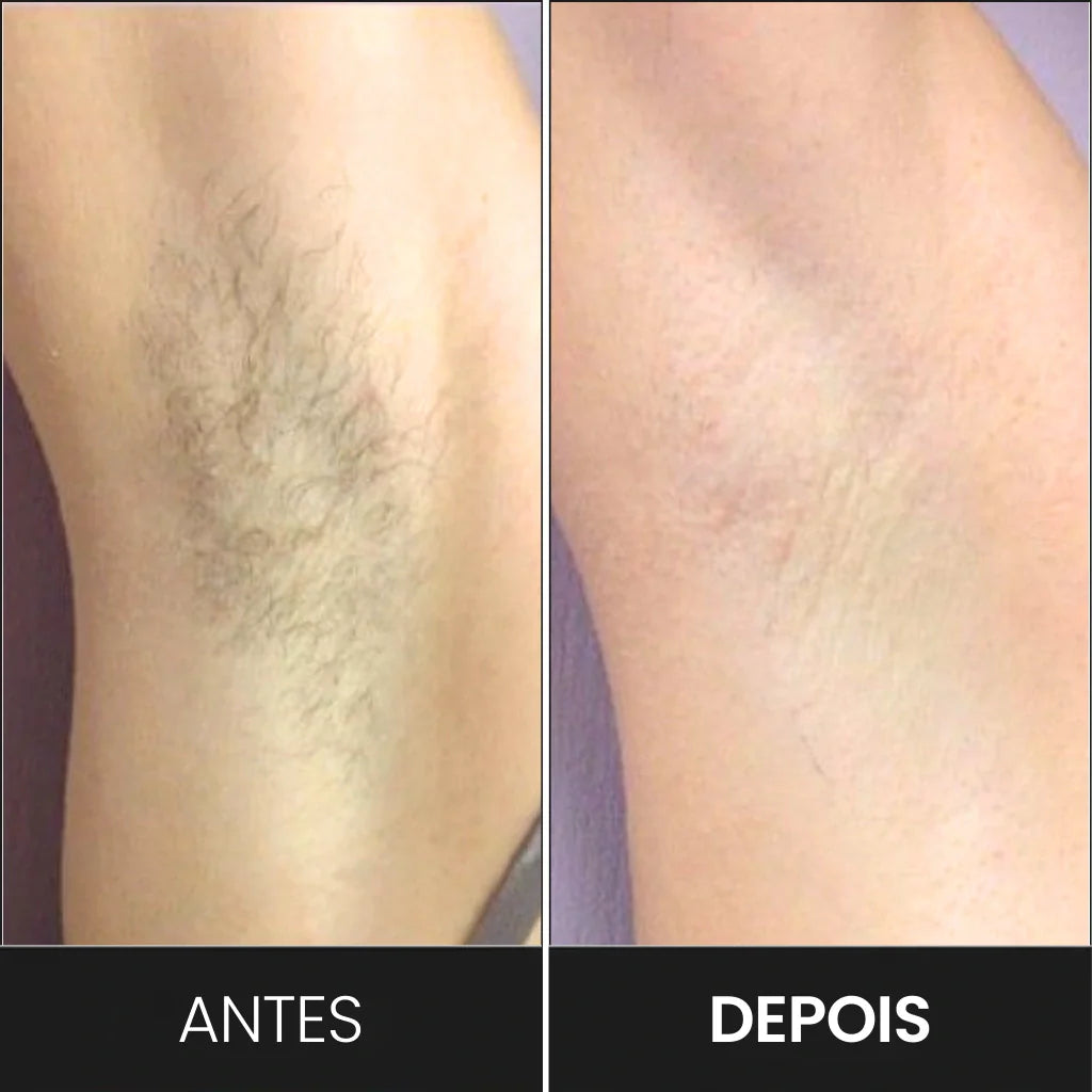 Depilador IPL Laser™